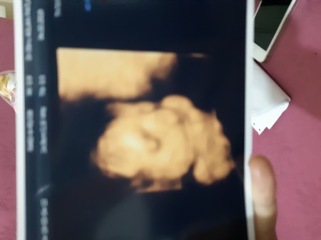 ultrasonda bebeğin saçı görünür mü